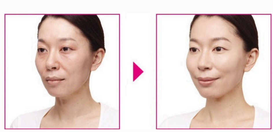 Balloon Concealer EX-2.jpg